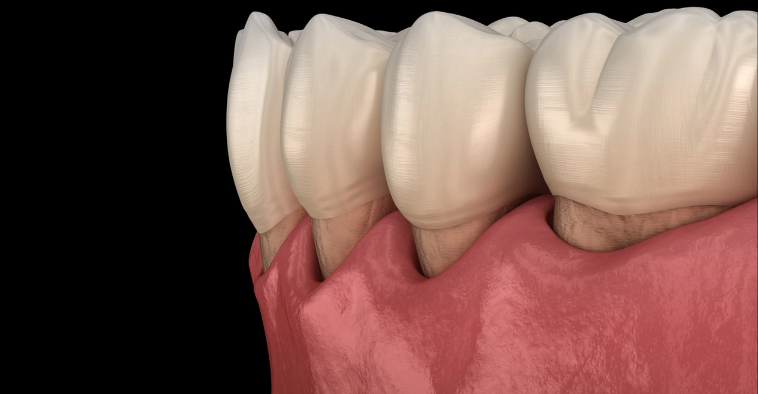 Can You Reverse Periodontal Disease 2